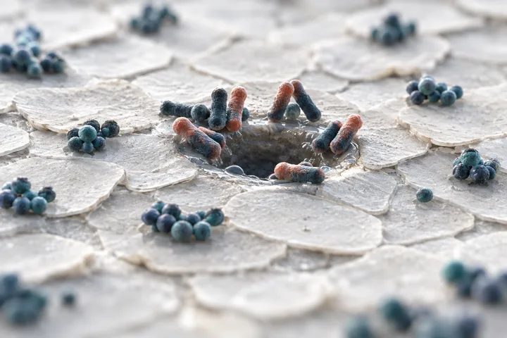 Illustration: grape-like clusters of round bacteria on flat skin surface cells, and coral short rods at the rim of a pore